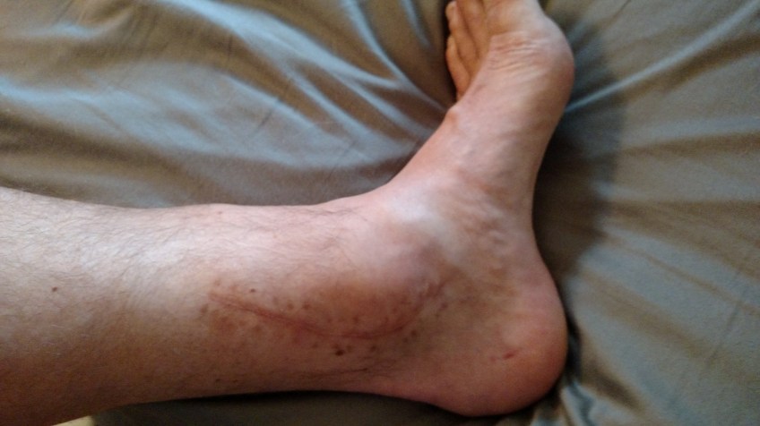 inside of left ankle, suture-line 5.5 months post pilon fracture surgery