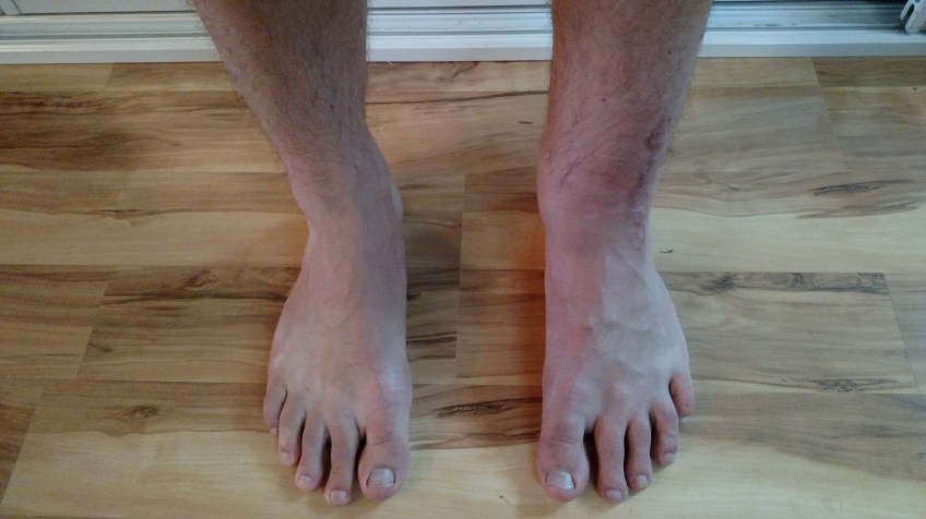 left and right comparission 5.5 months post pilon fracture surgery